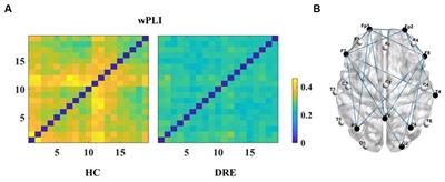 Alterations in brain network functional connectivity and topological properties in DRE patients